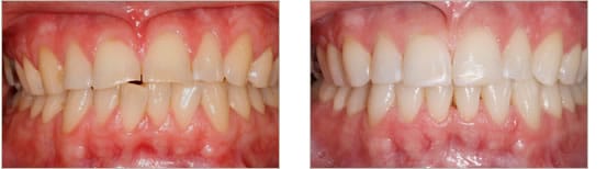 Before and after dental treatment