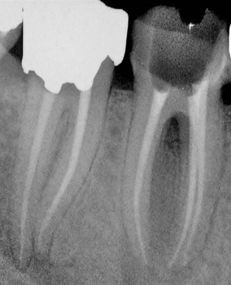 Root canal treatment